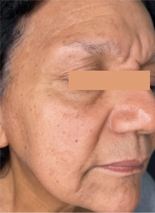 Patient after Forehead Lines showing softened in 14 days