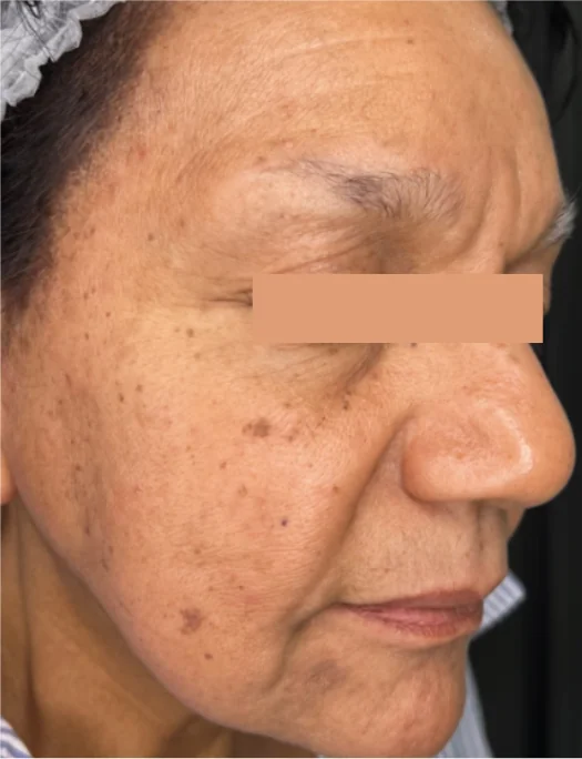 Patient before Forehead Lines treatment at IRIS Aesthetics