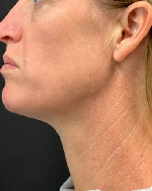 Patient after Mid-Face Lift showing restored youthful contour
