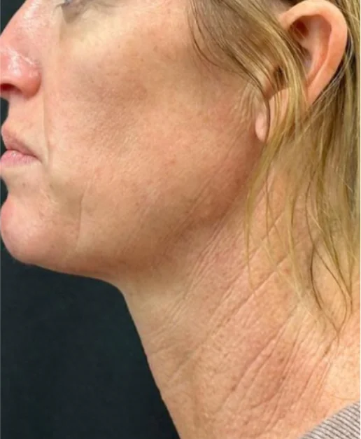 Patient before Mid-Face Lift treatment at IRIS Aesthetics