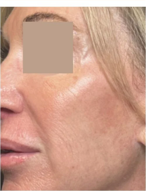 Patient after Signature Facial showing brighter, hydrated skin