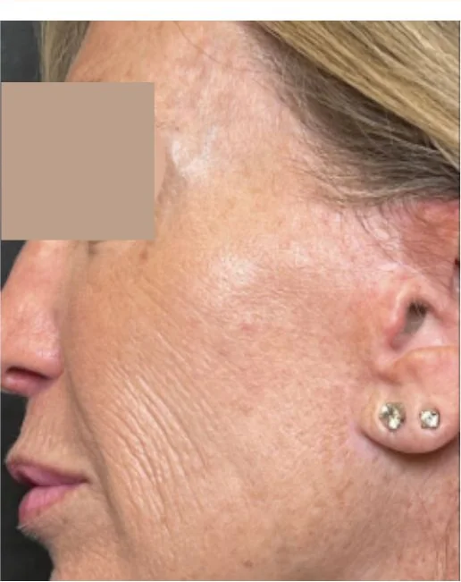 Patient before Signature Facial treatment at IRIS Aesthetics