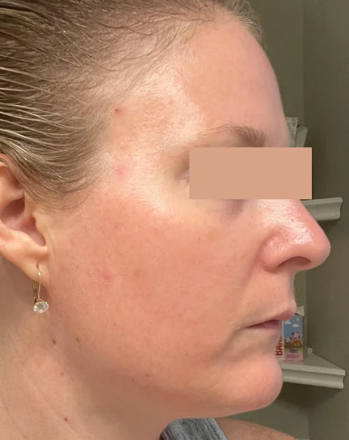 Patient after Endoscopic Brow Lift showing refreshed upper face