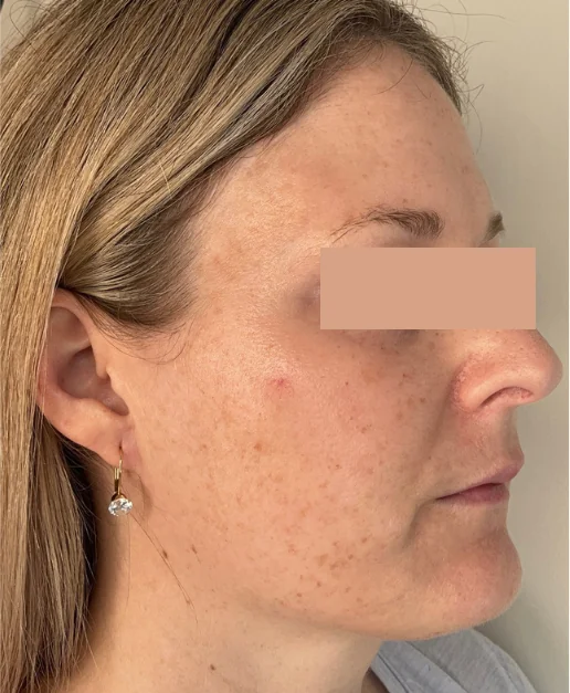 Patient before Endoscopic Brow Lift treatment at IRIS Aesthetics