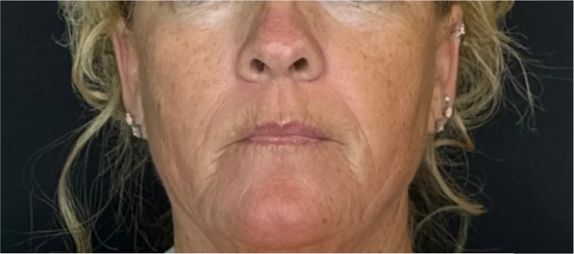 Patient before Neck Lift treatment at IRIS Aesthetics