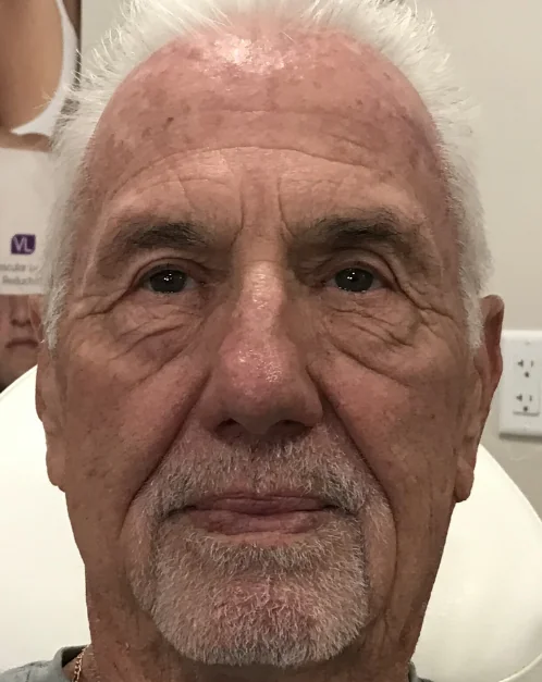 Patient after Dermaplaning showing smooth, polished texture