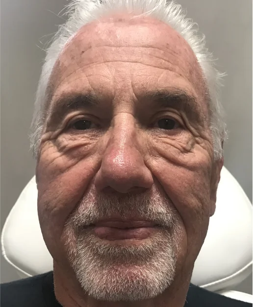 Patient before Dermaplaning treatment at IRIS Aesthetics