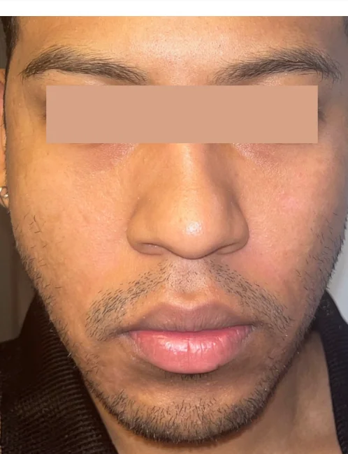 Patient after Level 1 Peel showing brighter, smoother tone