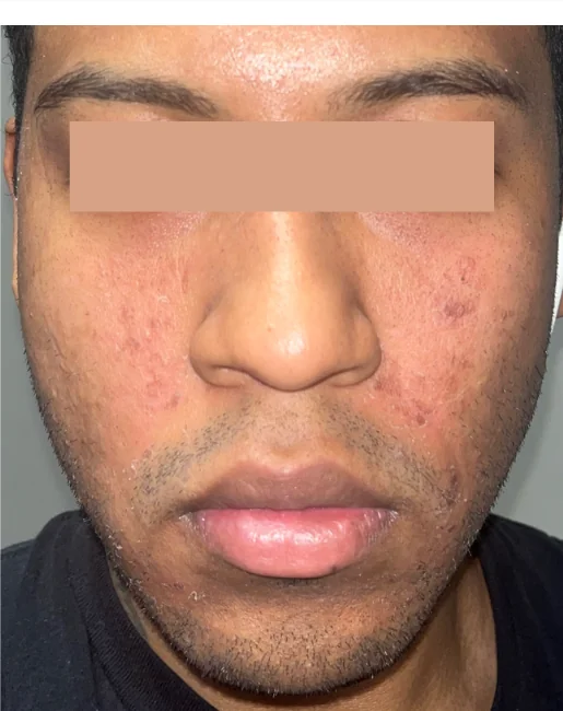 Patient before Level 1 Peel treatment at IRIS Aesthetics
