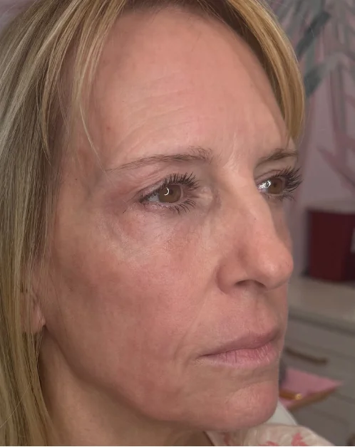 Patient after Level 3 Peel showing reduced sun damage