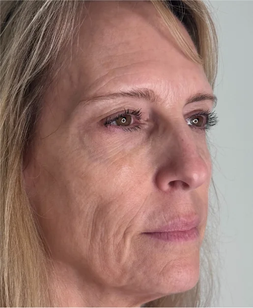 Patient before Level 3 Peel treatment at IRIS Aesthetics