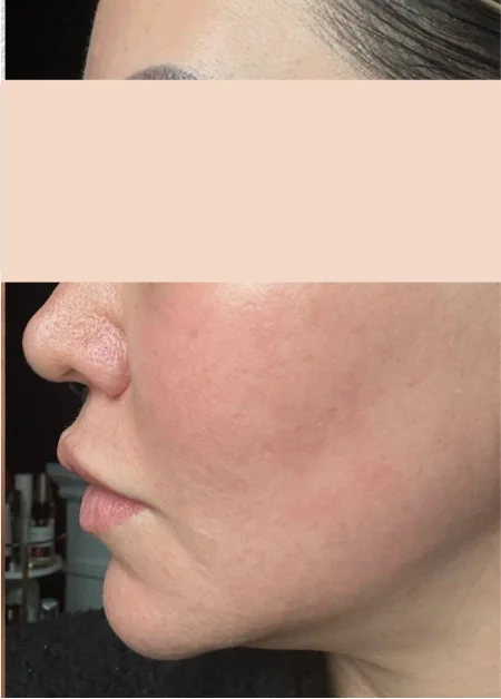 Patient after IPL Single Session showing cleared sun spots