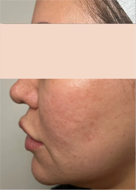 Patient before IPL Single Session treatment at IRIS Aesthetics