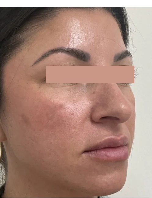 Patient after Face & Neck showing smooth and hair-free skin