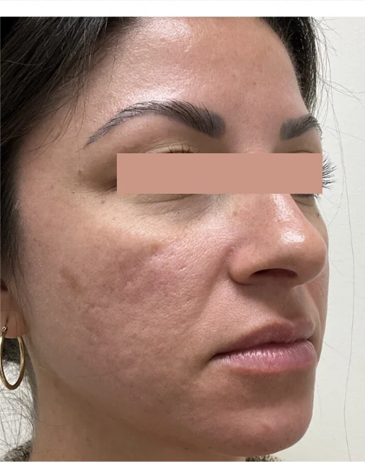 Patient before Face & Neck treatment at IRIS Aesthetics