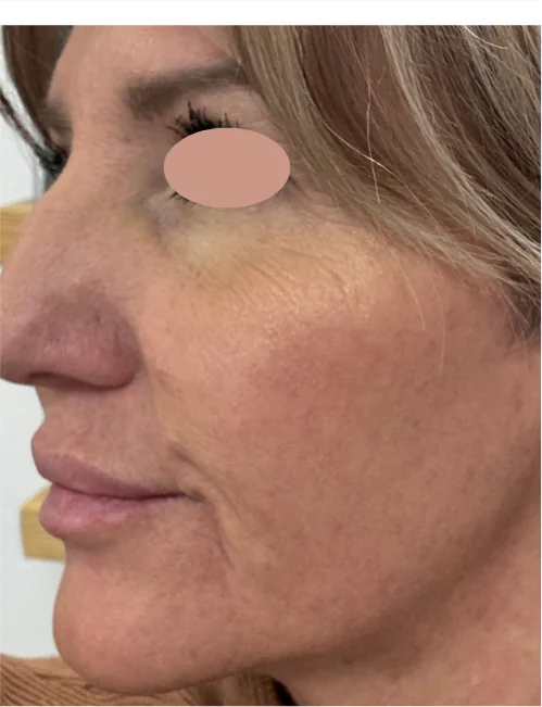 Patient after Microneedling showing smoother skin texture