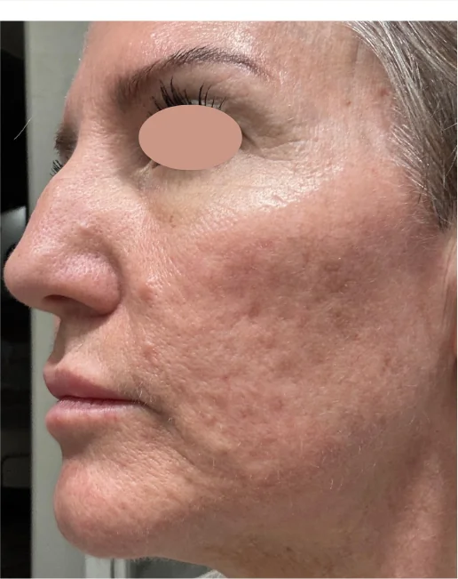 Patient before Microneedling treatment at IRIS Aesthetics