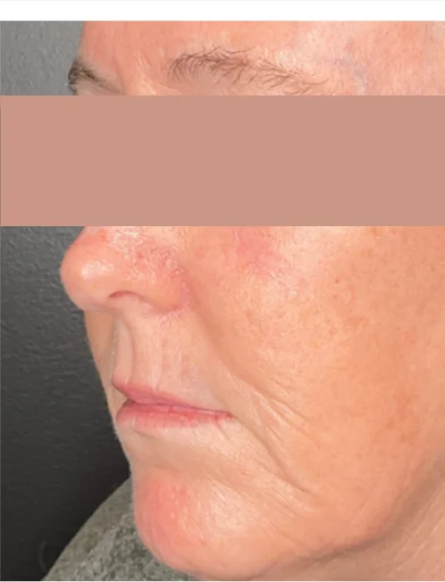 Patient after Cheek Fillers showing restored midface