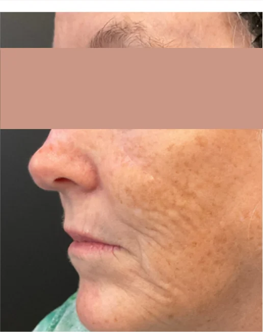 Patient before Cheek Fillers treatment at IRIS Aesthetics
