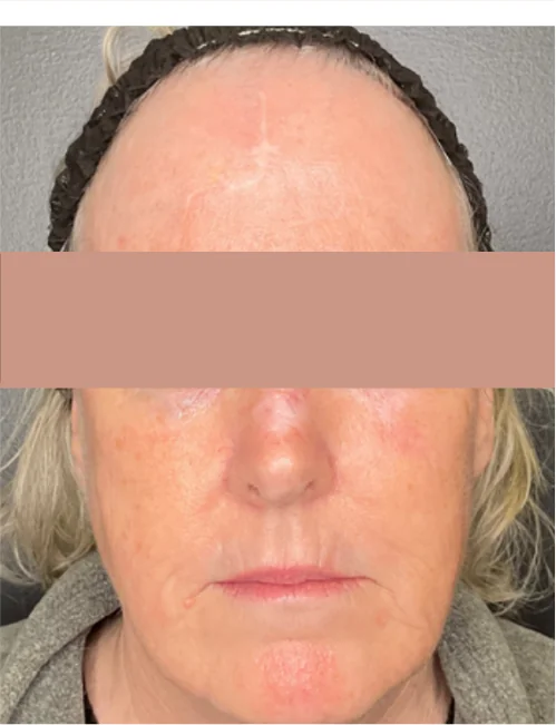 Patient after Lip Fillers showing subtle definition