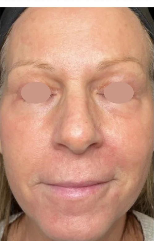 Patient after Series of 3 showing reduced acne scars