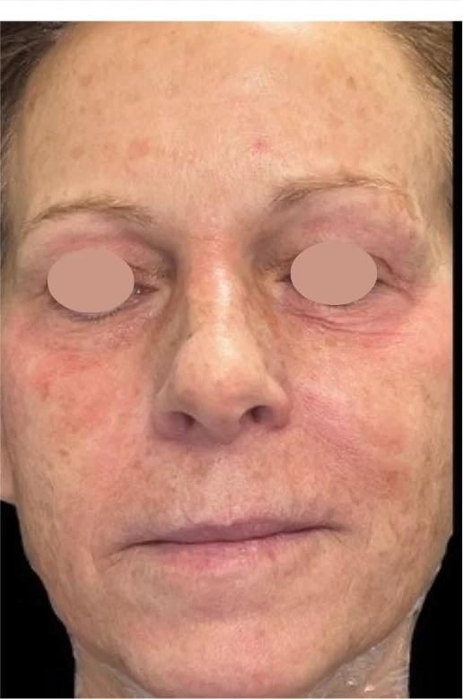 Patient before Series of 3 treatment at IRIS Aesthetics